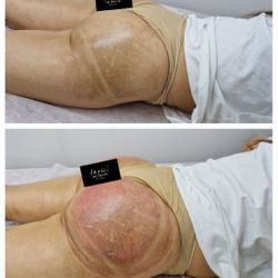 bumlift treatment